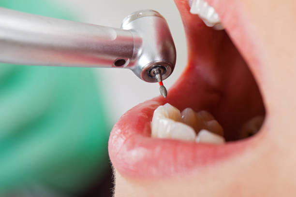 Best Knocked-Out Tooth (Avulsed Tooth) Treatment in Telluride, CO
